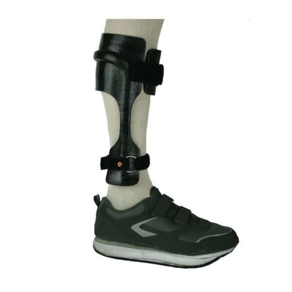 Patient leg wearing posterior cuff carbon fiber AFO